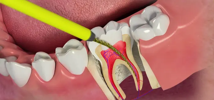 عصب کشی دندان چیست،مراحل عصب کشی دندان 