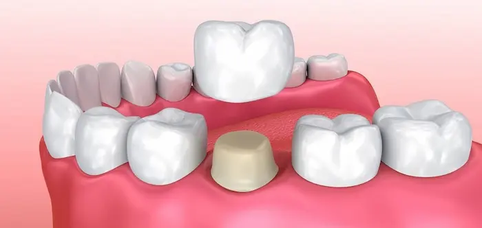 بهترین روکش دندان چیست؟، روکش دندان پرسلن بر روی دندان شکسته شده 