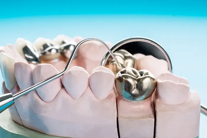 بهترین روکش دندان چیست؟، روکش فلزی برروی دندان مصنوعی 