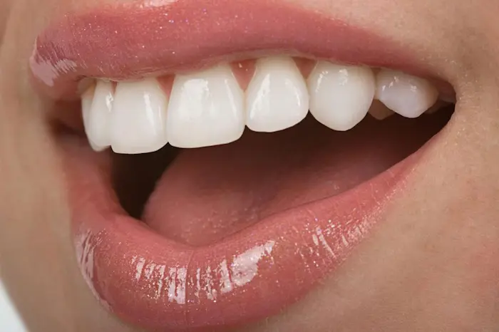 لبخند رضایت خانم از بلیچینگ دندان 