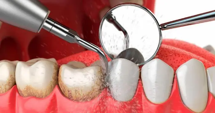 جرم گیری دندان چیست؟، جرم گیری دندان با ابزار های مخصوص