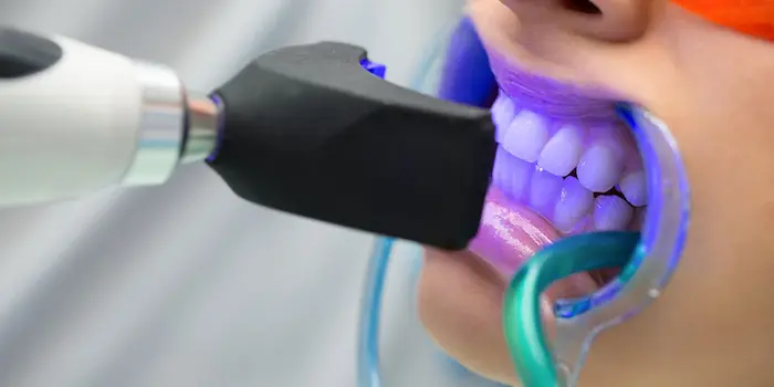 روش های نوین ترمیم دندان، مشخص کردن پوسیدگی با استفاده از لیزر 