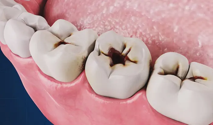 درمان دندان 