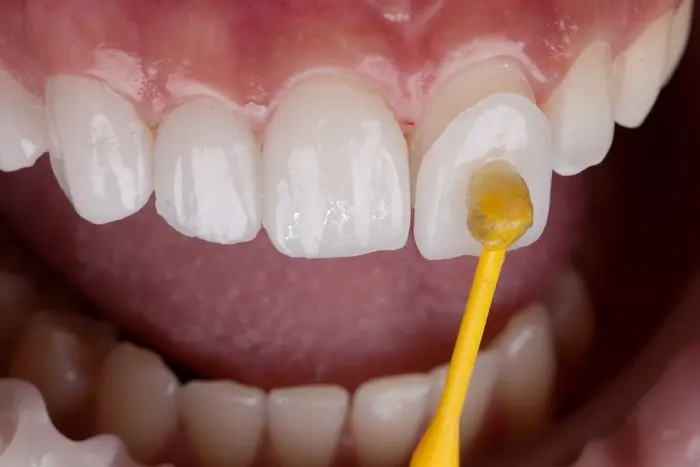 نمایی نزدیک از انجام کامپوزیت دندان بر روی دندان