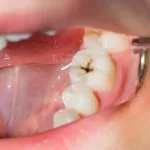 5 روش قطعی برای درمان پوسیدگی دندان!
