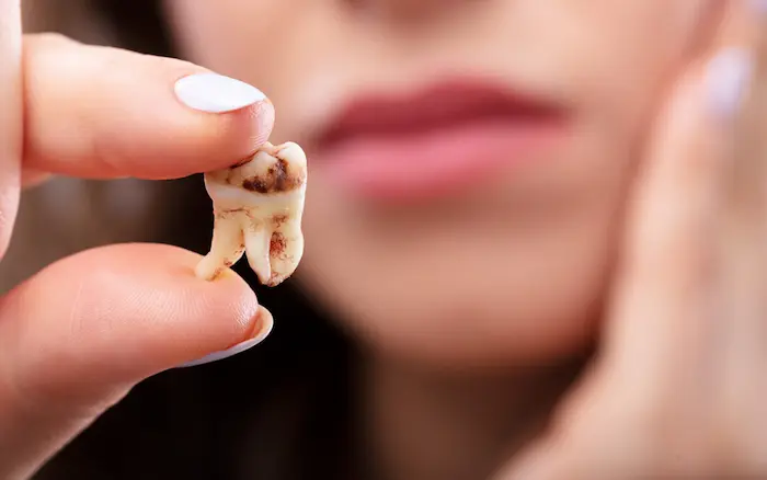 درمان پوسیدگی دندان 