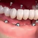 تمامی روش های کاشت دندان+معرفی بهترین روش