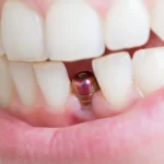 علت مورد اطمینان بودن کاشت دندان چیست؟