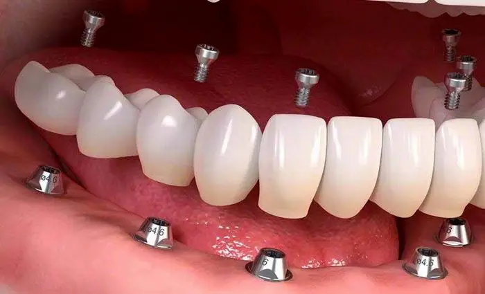 ایمپلنت همه دندان ها 