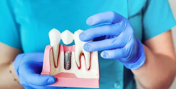 بریج دندان روشی پل مانند از روش های کاشت دندان 