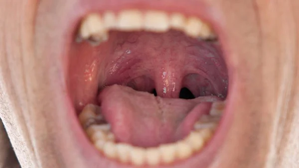 سرطان دهان در گرگان 2346575586120