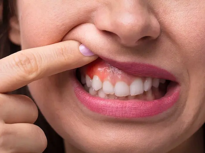 نمایی از علائم سرطان دهان بر روی لثه دندان خانم 
