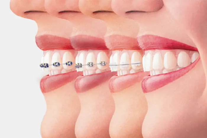 ارتودنسی دندان 87511111
