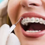 4 دلیل زرد شدن دندان بعد از ارتودنسی | روش های پیشگیری