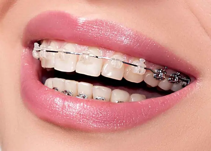 ارتودنسی دندان 7854120