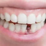 علائم عفونت ایمپلنت دندان | روش های درمان آن