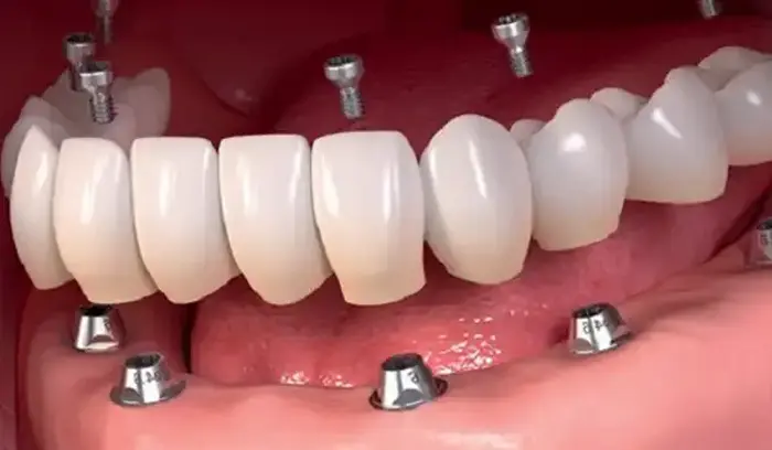 ایمپلنت دندان 2215428755
