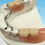 توضیح بریج دندان | مزایا + مراقبت های بعد از بریج دندان