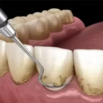 پلاک دندان چیست؟ | روش های خانگی از بین بردن آن