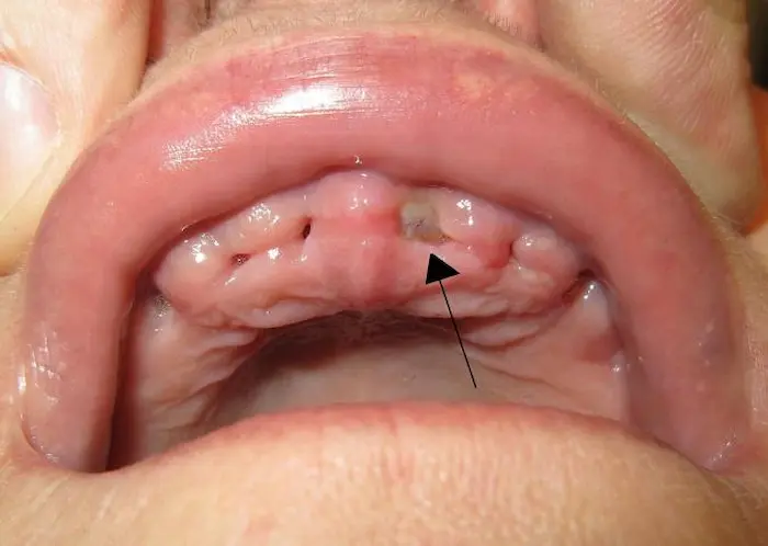 نشانه های بروز بیماری حفره خشک دهان در دندان
