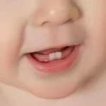 دندان های شیری | پوسیدگی دندان شیری + ترمیم