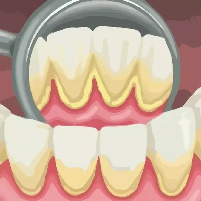 پلاک دندان 441524