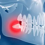دندان عقل چیست ؟ | علائم + نکات و مراقبت های بعد از جراحی