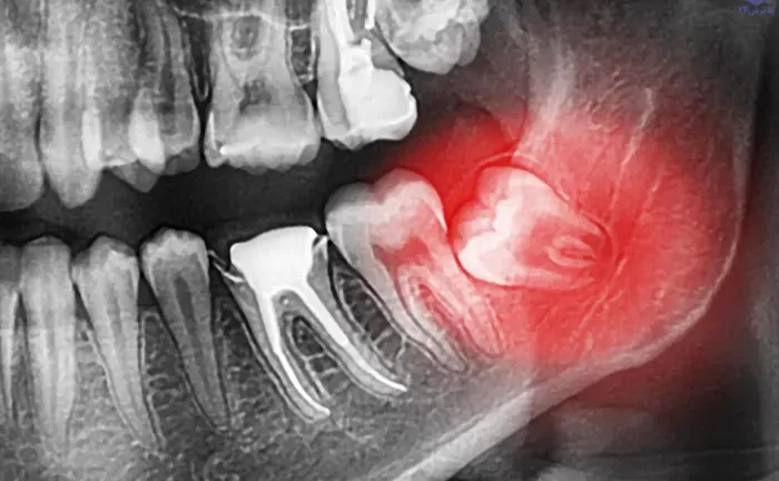 درد و آسیب دندان عقل به دندان های مجاور 4545