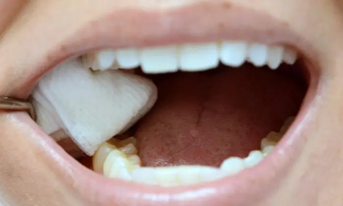 فشار دادن گاز استریل روی دندان به منظور قطع فوری خونریزی دندان