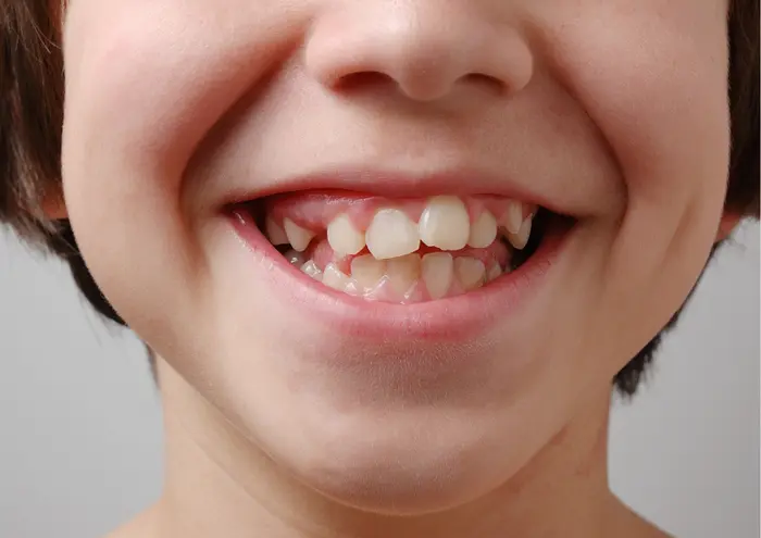نامنظمی دندان کودک 8454