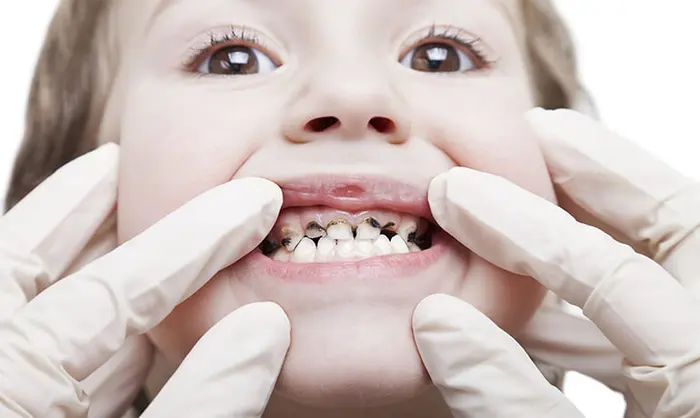 پوسیدگی دندان کودک 8745