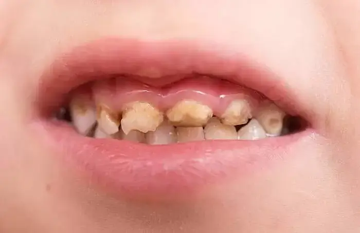 پوسیدگی دندان کودک 87454