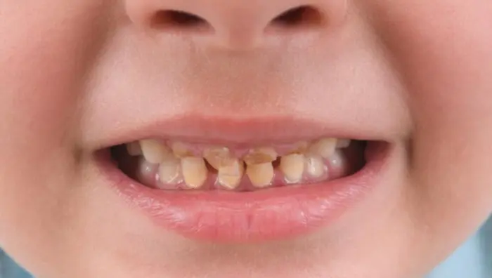 پوسیدگی دندان کودک 8454