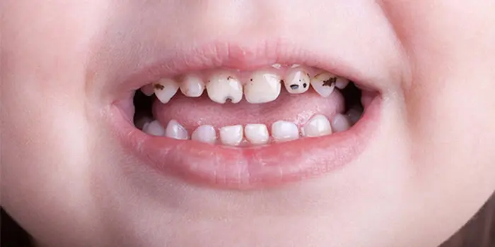 پوسیدگی دندان کودک 51352