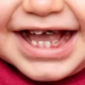 پوسیدگی دندان کودکان | روش جلوگیری + درمان