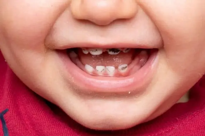 پوسیدگی دندان کودک 41524