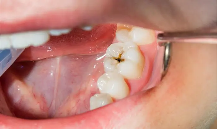 دندان سیاه شده در حال خراب 1564684