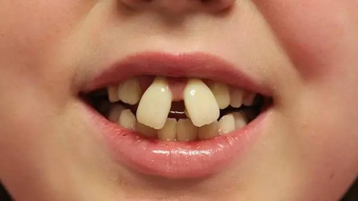 کودکی که دندان های فک بالا از هم فاصله دارد 1634684