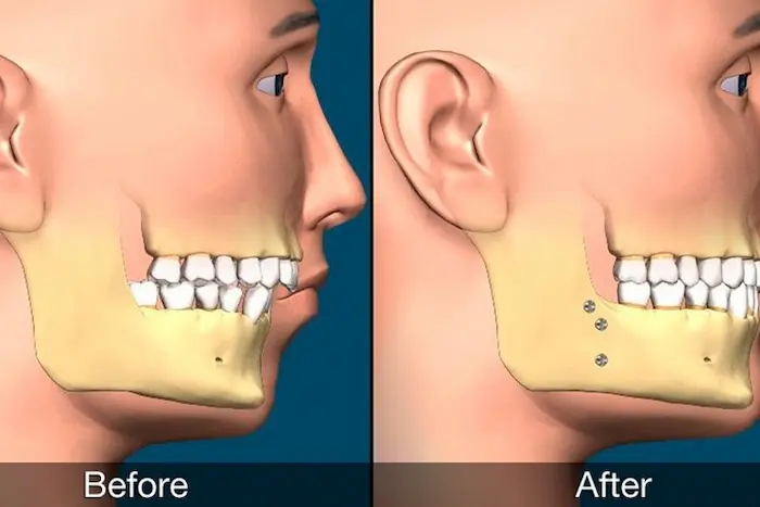 قبل و بعد عمل جراحی با گرگان دنتیست 5874654