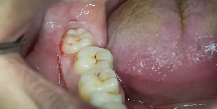 دندان عقل نهفته در اخر ردیف دهان بیمار 14564687