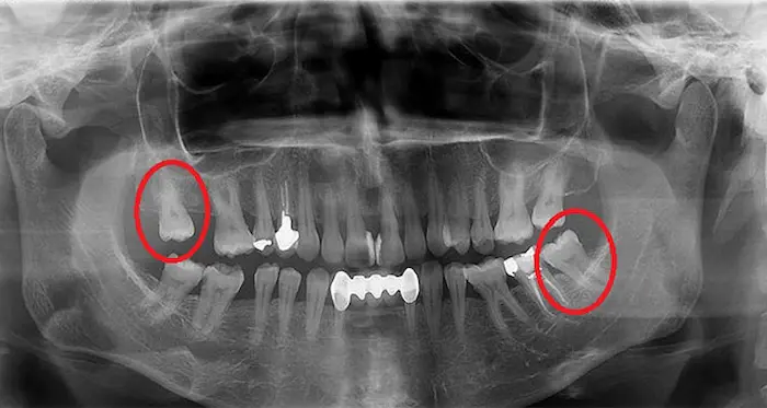 عکس پزشکی از دندان های عقل 156481748