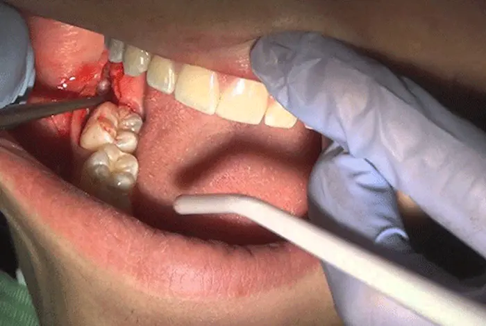 جراح دندان های عقل بیمار توسط پزشک معالج 15649878677