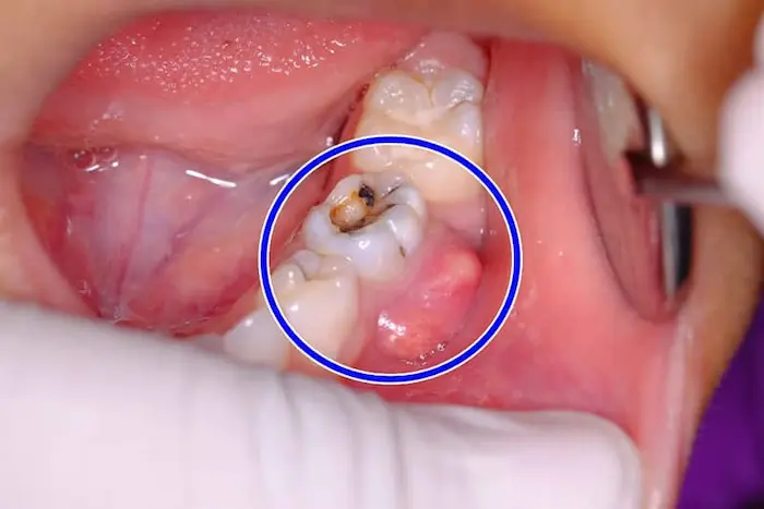  عکس بیمار مبتلا به پوسیدگی دندان 54848978487