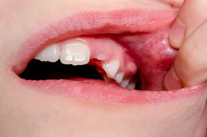 عکس بیمار مبتلا به آبسه دندان 48649987987