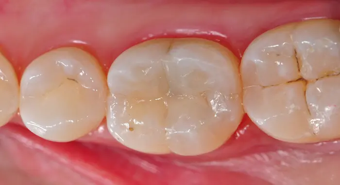 معاینه دندان های بیمار در حال عفونت تدریجی 156874684