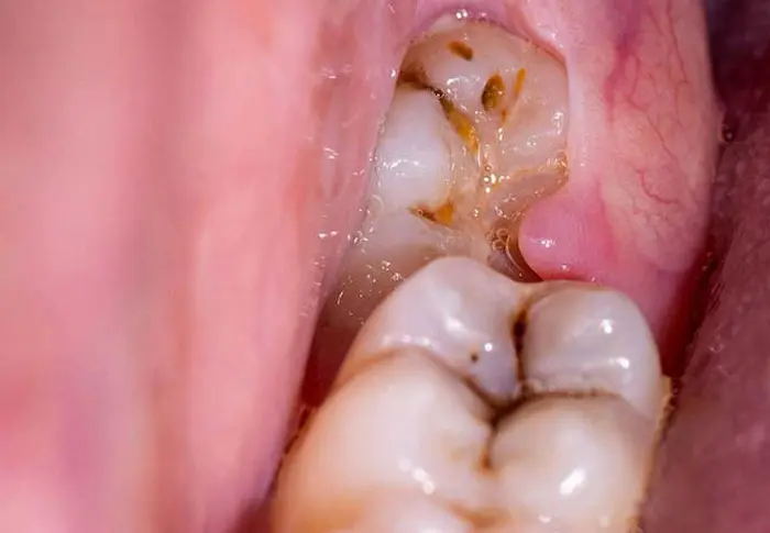 عکس دندان پوسیده و سیاه شده در بیمار 563468486