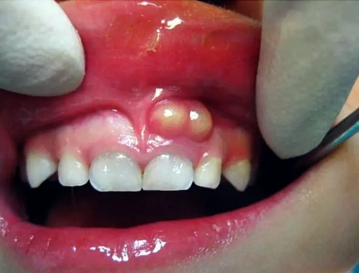 تورم شدید خانم مبتلا به آبسه دندان 879745