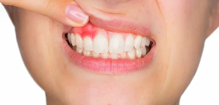 بیمار مبتلا به آبسه در فک بالا یکی از علت های تیر کشیدن دندان است 4586746