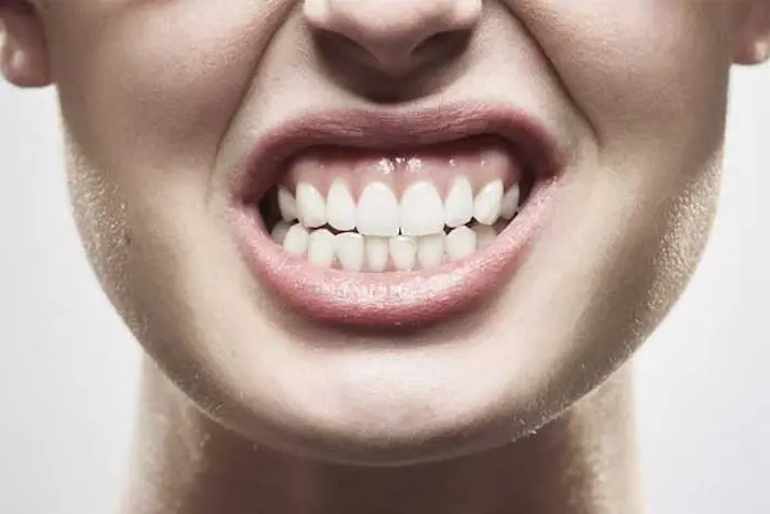 دندان قروچه یکی از علائم تیر کشیدن دندان 45847864