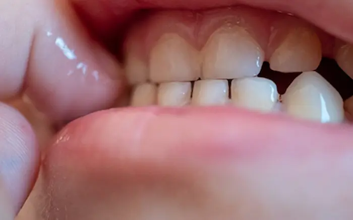 دندان قروچه در دهان بیمار 46874674